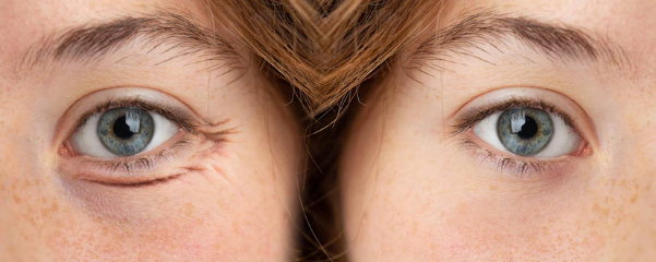 5 cách khắc phục quầng thâm dưới mắt hiệu quả tại nhà-1