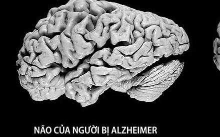 Thuốc chữa tăng động có thể cải thiện triệu chứng của bệnh Alzheimer-2