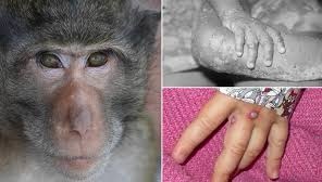 WHO: Chỉ trong 1 tuần qua, bệnh đậu mùa khỉ đã tăng 20%-5