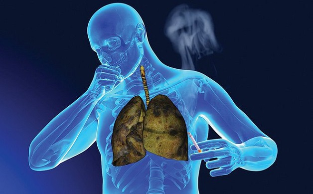 Điều trị bệnh nhân ung thư phổi muộn bằng liệu pháp miễn dịch-1