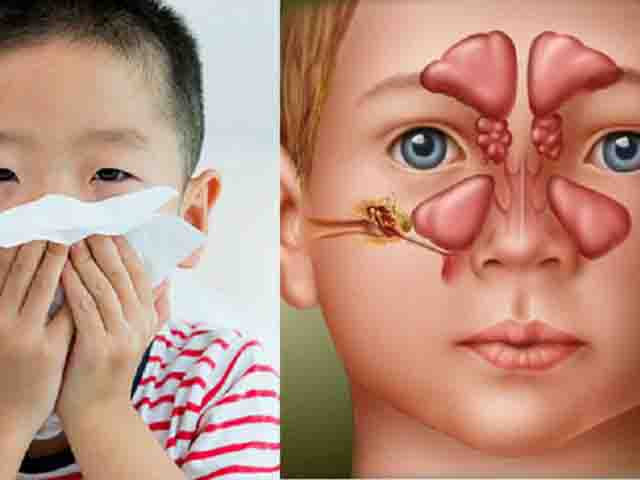 Cảnh giác với viêm mũi xoang cấp do vi khuẩn ở trẻ-2