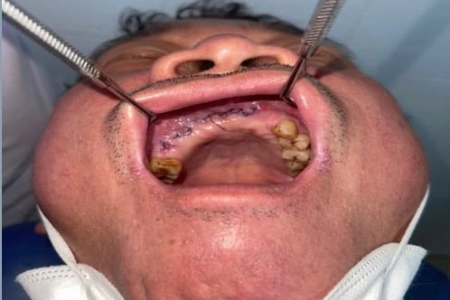 Bệnh nhân bỗng dưng lung lay 7 răng, dùng tay lấy ra được sau mắc Covid-19-1