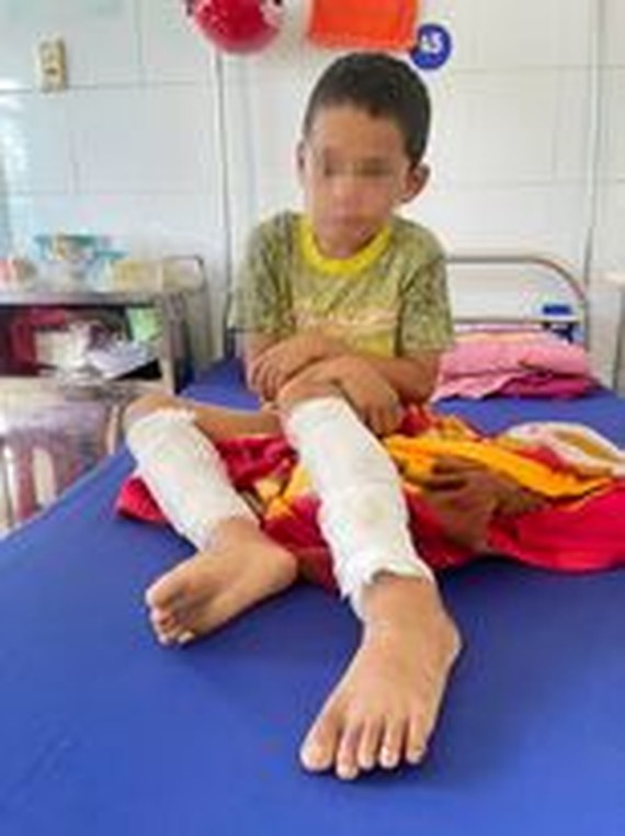 Quảng Bình: Phẫn nộ bé trai lớp 3 bị cha dùng xăng và rơm đốt cháy hai chân-1