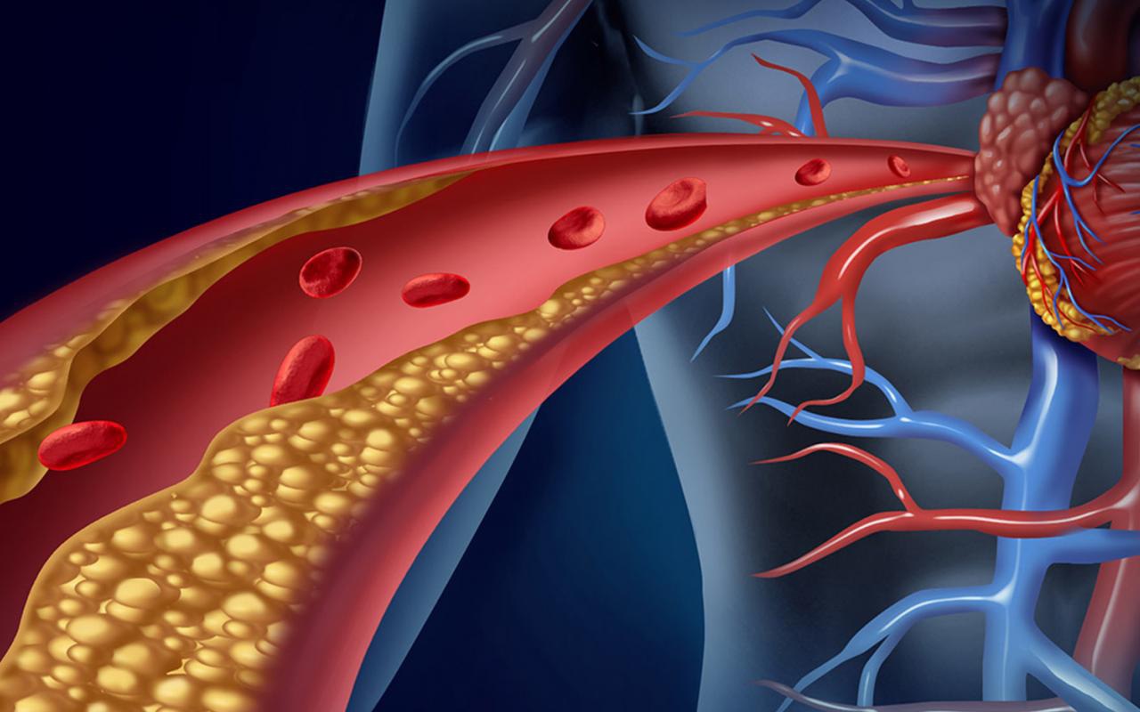 Bác sĩ tim mạch Mỹ: Dấu hiệu cảnh báo lượng cholesterol tăng cao, có một cũng cần đi khám ngay-1