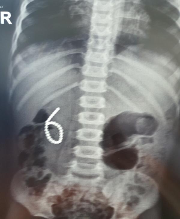 Thanh Hóa phẫu thuật thành công lấy 28 viên nam châm trong dạ dày, tá tràng bé trai 4 tuổi-1