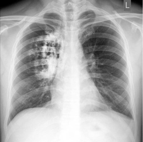 4 dấu hiệu bất thường ở đầu cảnh báo ung thư phổi, bạn có thể gặp triệu chứng này mà không hay biết-1