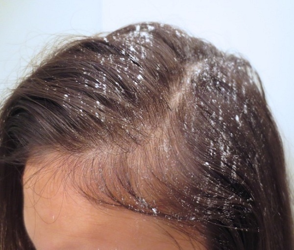 Mách bạn 4 cách trị tóc bết hiệu quả tại nhà-3