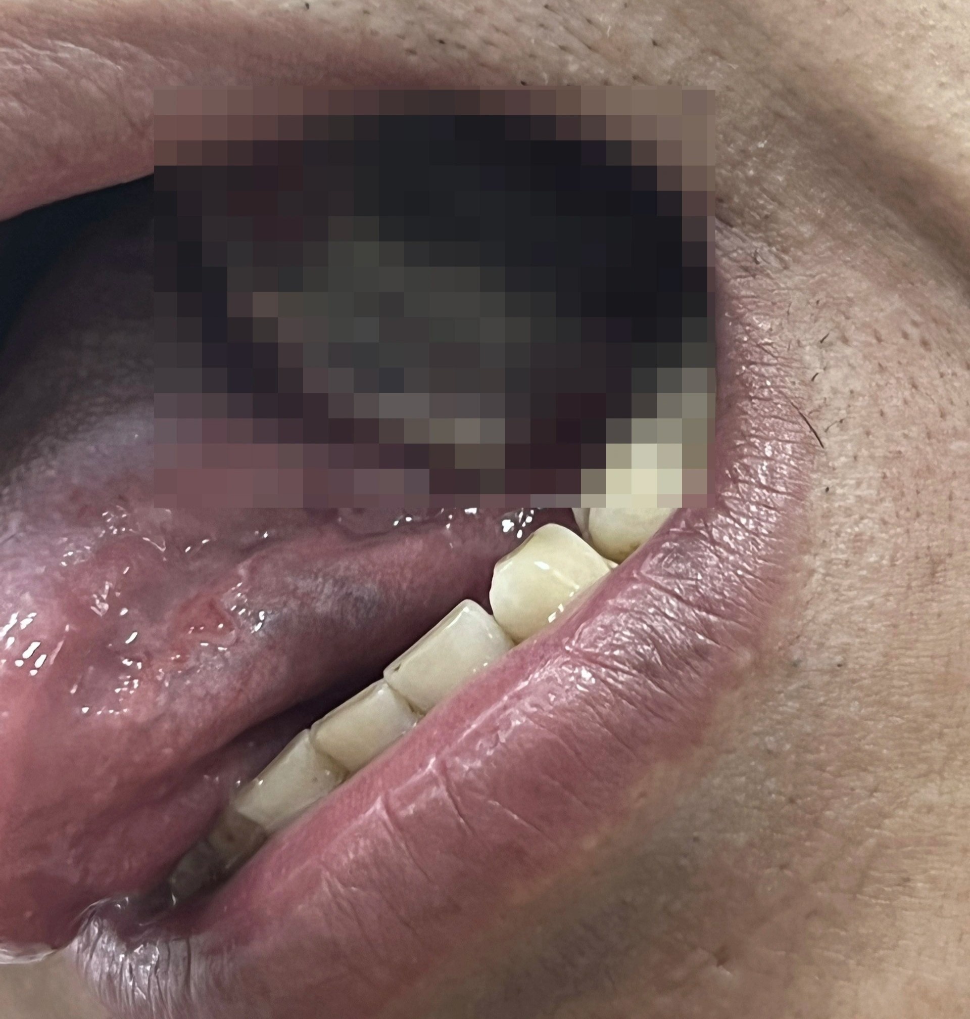 Đi khám do nhiệt miệng, người đàn ông được phát hiện ung thư lưỡi-1