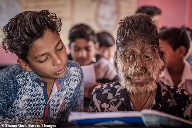 Ấn Độ: Nghị lực sống và tinh thần lạc quan của chàng trai "người sói"-2