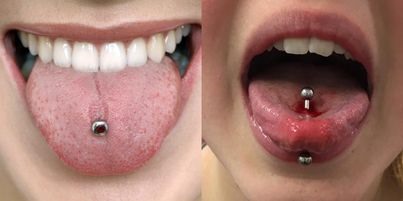 Xỏ khuyên lưỡi có thể gây ảnh hưởng đến răng và nướu-1