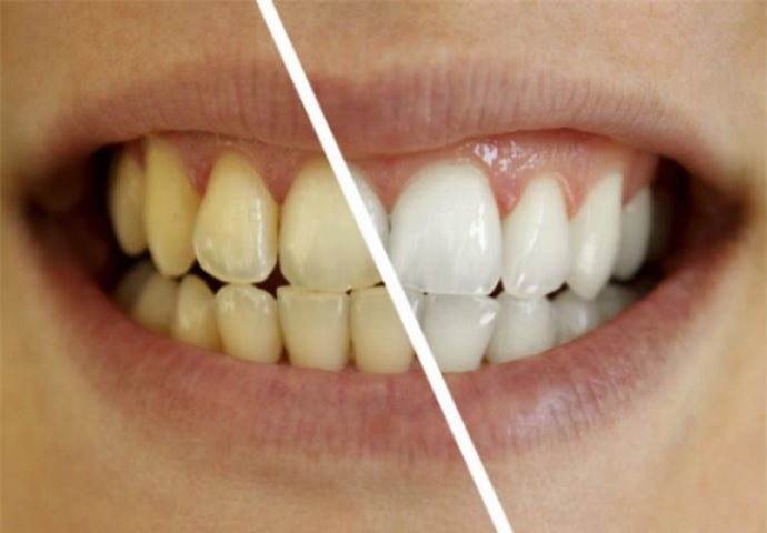Cách đơn giản để giải quyết răng ố vàng bạn phải biết-1