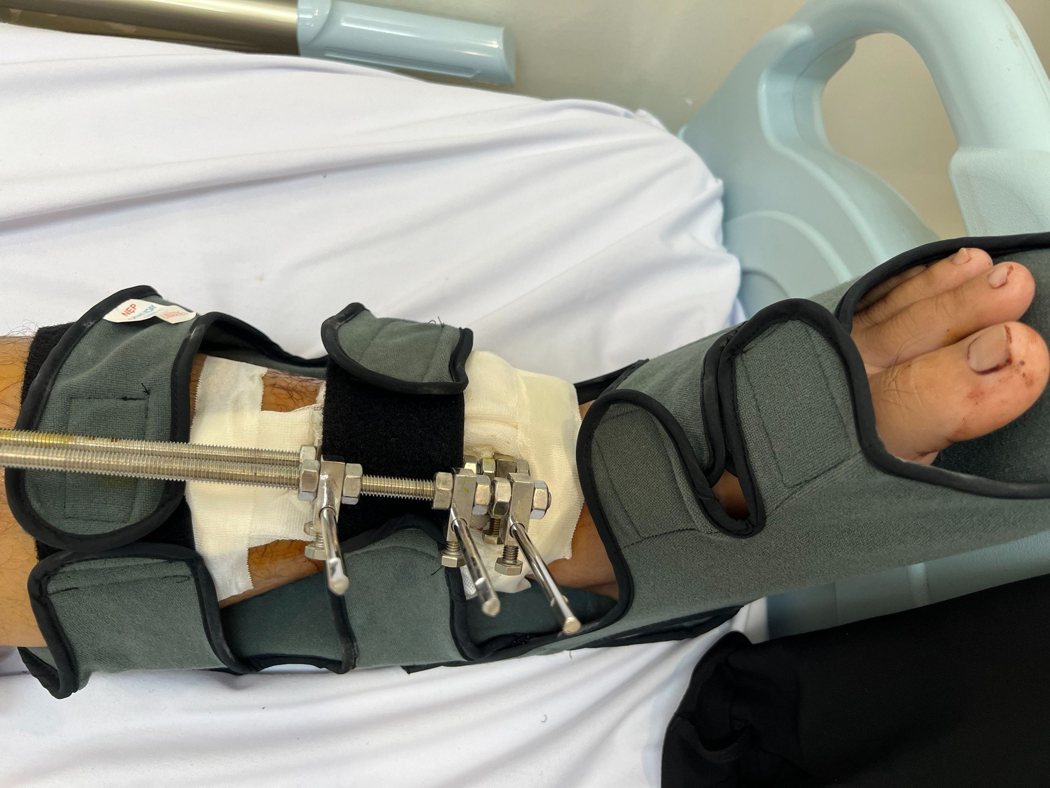 Xuyên đêm phẫu thuật cứu bệnh nhân Campuchia bị máy cắt cỏ cắt gần lìa chân-2