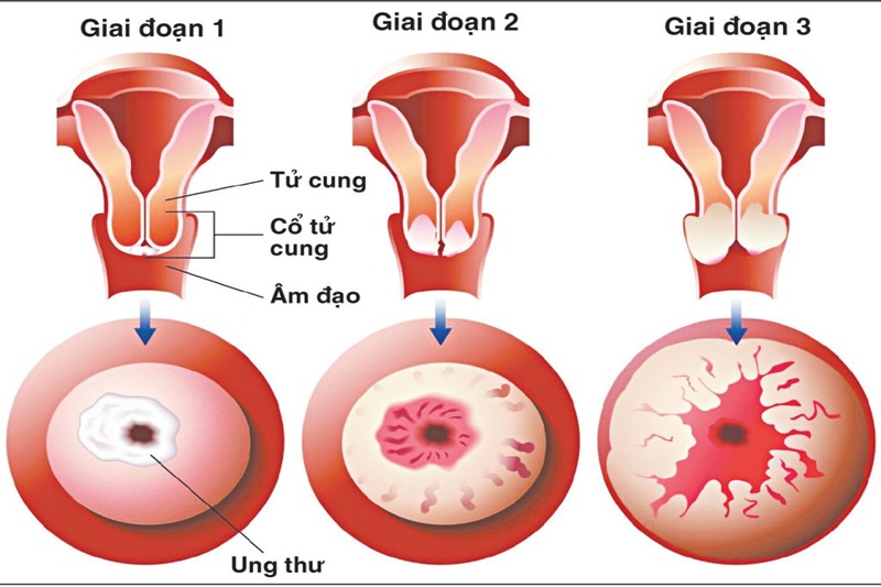 Những biến chứng nguy hiểm do ung thư cổ tử cung-1