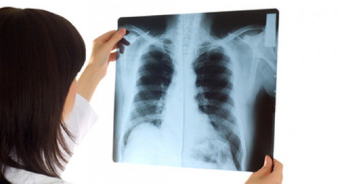 Những ai cần chụp CT phổi liều thấp để sàng lọc ung thư phổi?-2