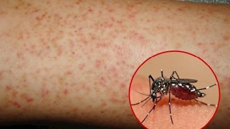 Hà Nội ghi nhận thêm 8 ổ dịch mới, triệu chứng cảnh báo nguy hiểm của sốt xuất huyết-1
