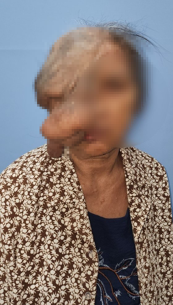 Cụ bà 73 tuổi bị khối u dị dạng "ăn" một bên mắt, thoát vị não-1