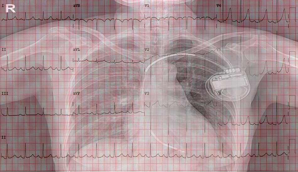 Cứu bệnh nhân người Úc bằng kỹ thuật đặt máy tái đồng bộ nhịp tim-3