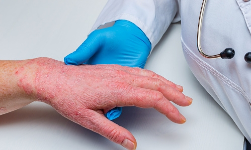 Cách điều trị và phòng tránh bệnh ngoài da thường gặp-2