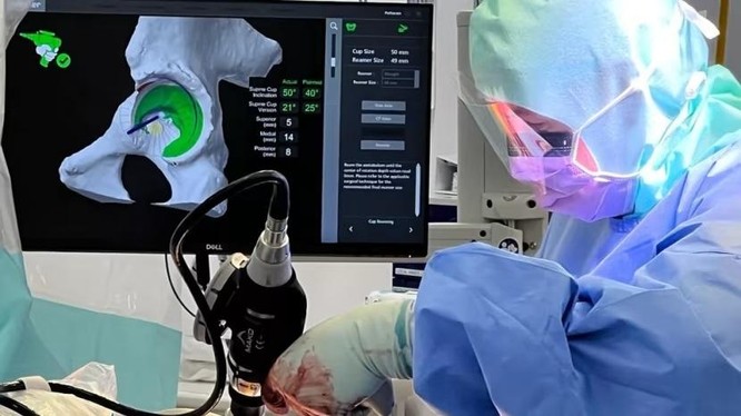 Các bác sĩ phẫu thuật Anh thử nghiệm robot thay khớp háng cho bệnh nhân-1