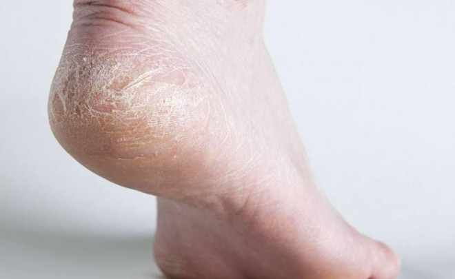 4 sai lầm khiến gót chân bạn luôn khô nứt nẻ, nên điều chỉnh ngay hôm nay-1