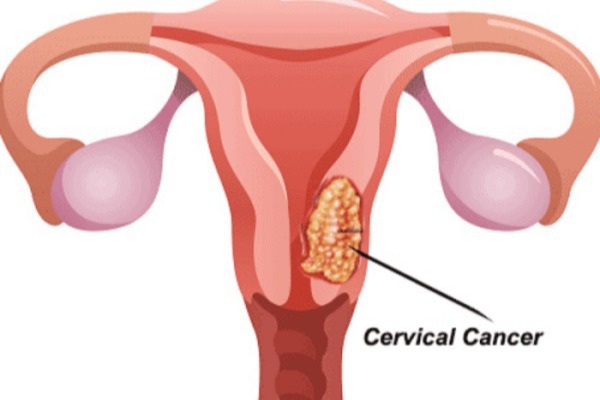 Dấu hiệu ung thư cổ tử cung giai đoạn 3-1