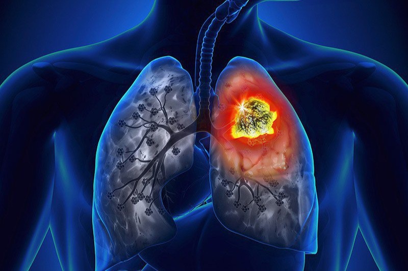 Những ai cần chụp CT phổi liều thấp để sàng lọc ung thư phổi?-1