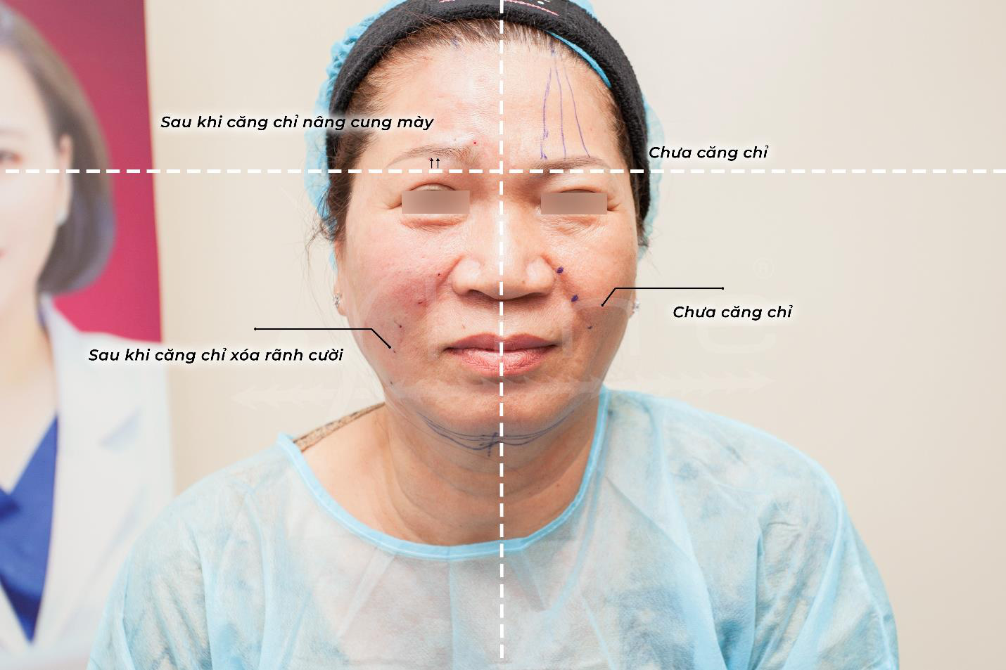 Bác sĩ Nguyễn Phương Thảo giải đáp những điều cần biết về căng da bằng chỉ-1