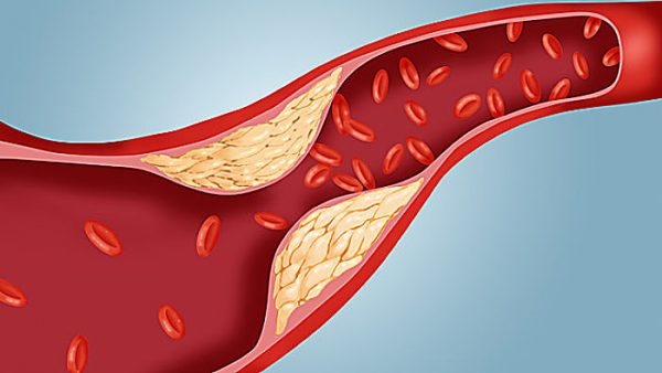 Thờ ơ với tình trạng thừa cholesterol, gần 50% người thành thị bị mỡ máu cao-1
