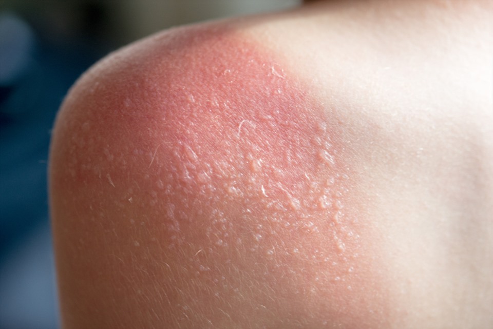 Những nguy cơ gây tổn hại sức khỏe khi bị cháy nắng-1