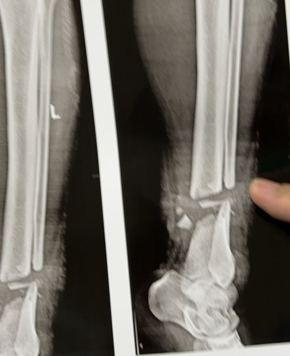 Xuyên đêm phẫu thuật cứu bệnh nhân Campuchia bị máy cắt cỏ cắt gần lìa chân-1