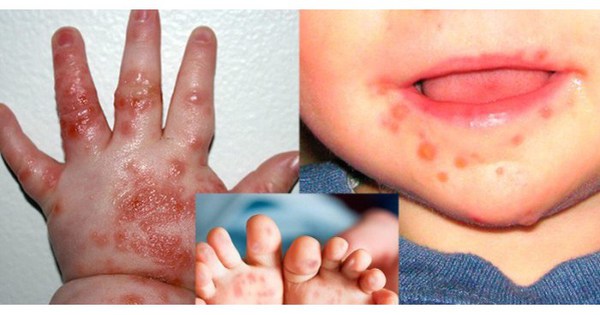 Trẻ có thể bị tay chân miệng và sốt xuất huyết cùng lúc không? Phân biệt vết loét do tay chân miệng gây ra-1