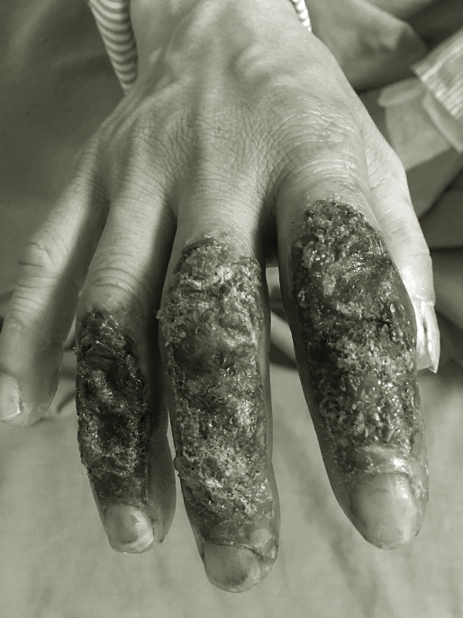 Thêm trường hợp lở loét, nhiễm trùng bàn tay do dùng lá thuốc chữa bỏng-1