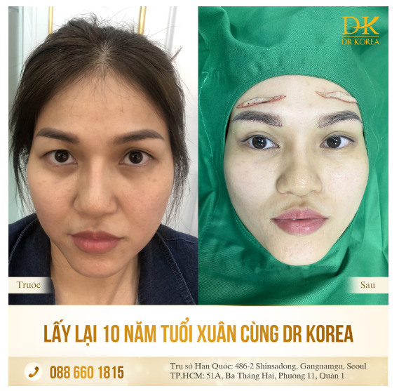 Nâng cung chân mày dấu sẹo tại Dr Korea - Xu hướng Trẻ hóa đôi mắt toàn diện-3