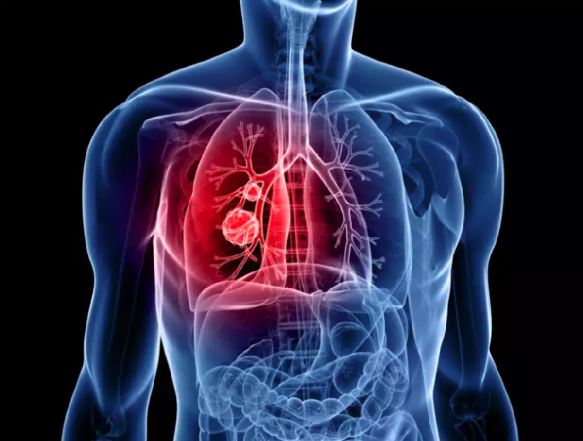 Các triệu chứng ban đầu của bệnh ung thư phổi cần đề phòng-2