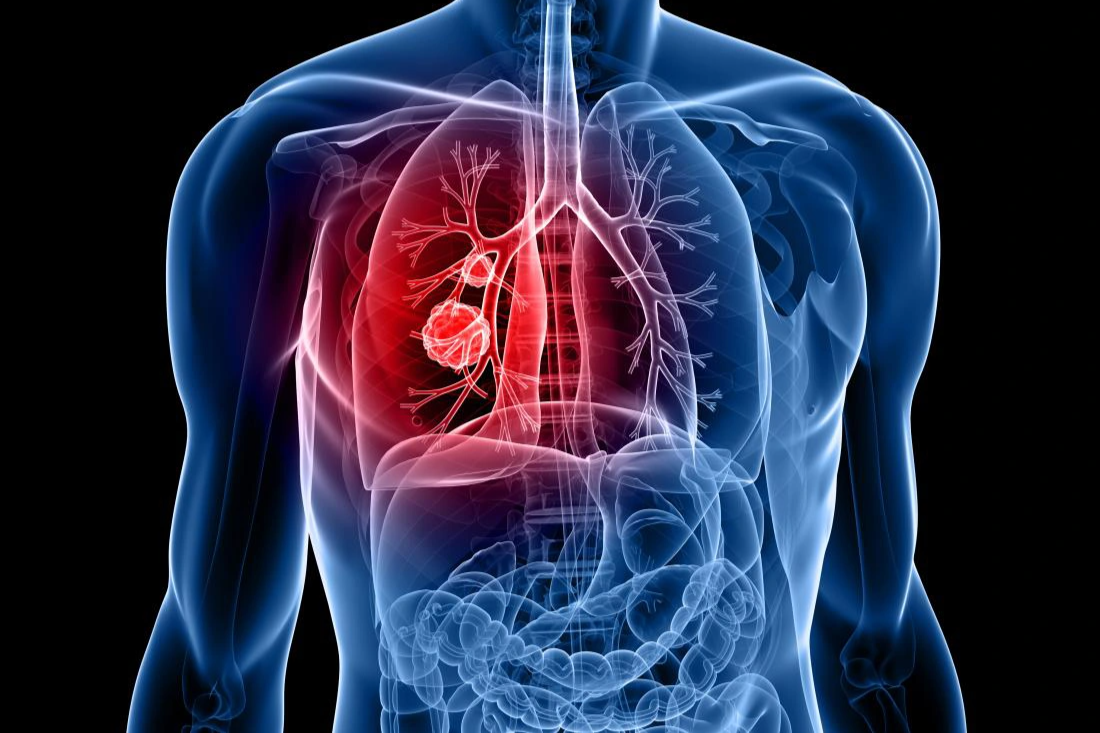 5 hiểu lầm phổ biến về ung thư phổi-1