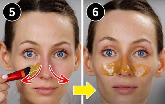4 cách để loại bỏ mụn đầu đen trên mũi của bạn-10