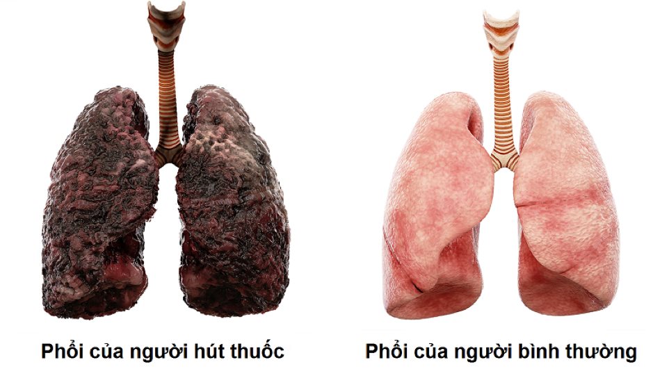 Mối quan hệ giữa hút thuốc lá và ung thư phổi-2