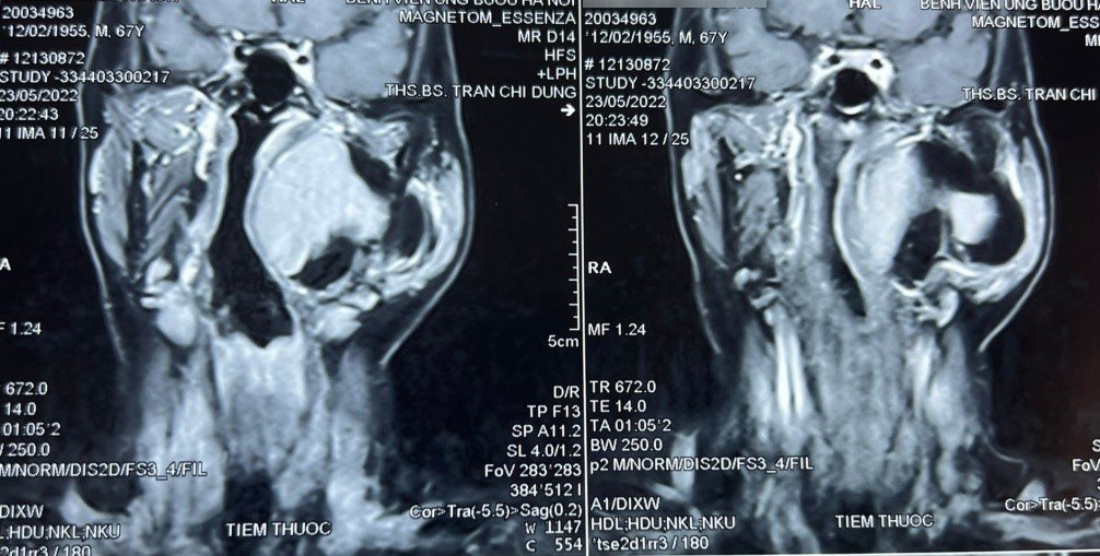 Sưng phồng vùng mang tai, nam bệnh nhân không ngờ mắc khối u hiếm gặp, phức tạp vùng đầu cổ-1