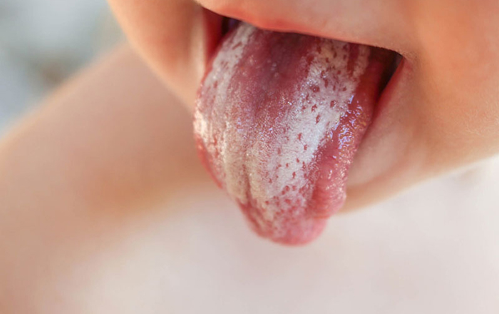 Nấm lưỡi, miệng ở trẻ: xử trí và phòng ngừa thế nào?-2