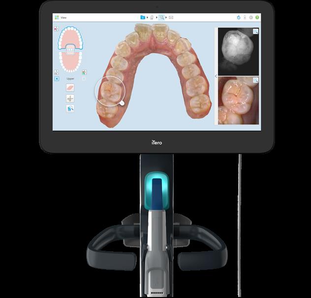 Ra mắt công nghệ scan dấu răng iTero 5D Plus-1