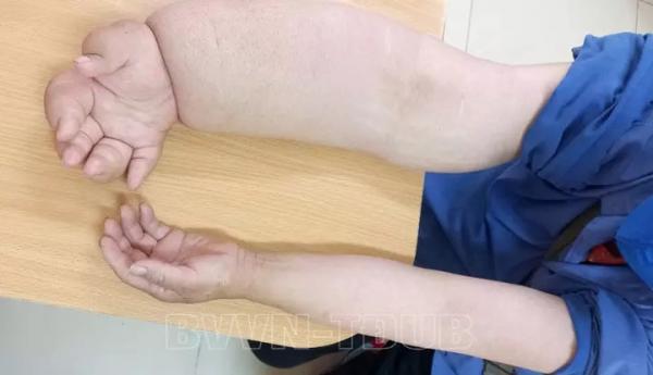 Hình ảnh cánh tay kỳ lạ của người phụ nữ mắc ung thư-1
