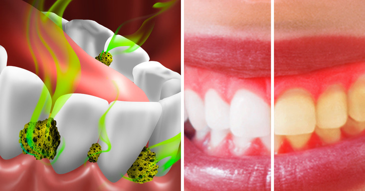 7 cách tiêu diệt vi khuẩn trong miệng và ngăn chặn hơi thở có mùi đơn giản nhất-6