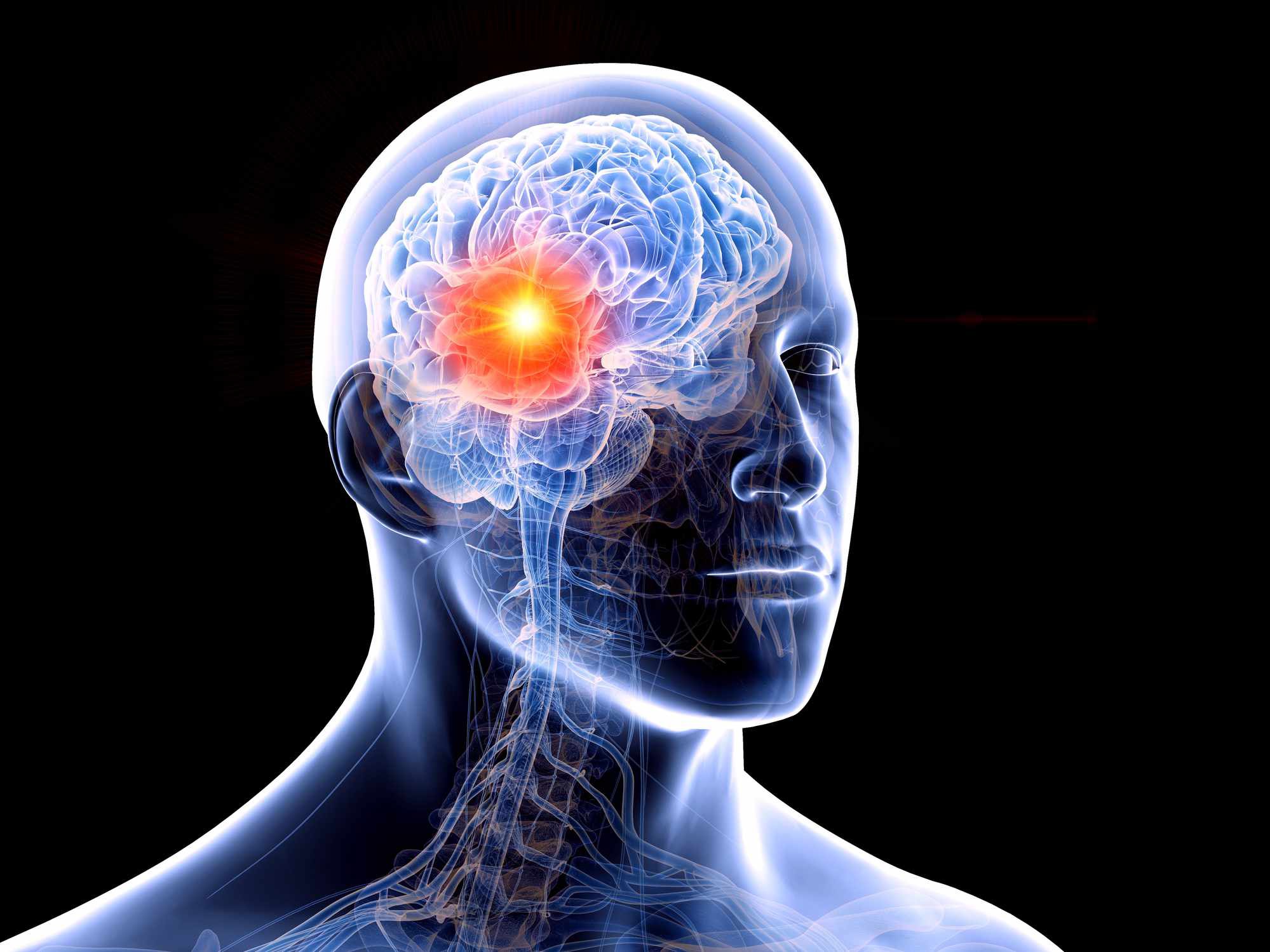 Các triệu chứng của u não ác tính giai đoạn cuối-2