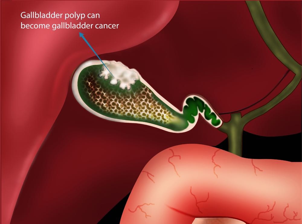 Polyp túi mật có phải là ung thư không?-1