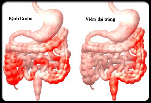 Bệnh Crohn - Những điều cần biết-1