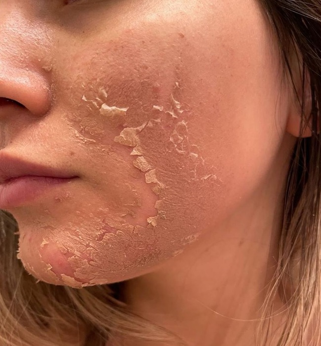 Chuyên gia chỉ ra 3 bước thiết yếu cần làm ngay để da đẹp và ngăn ngừa nám-2