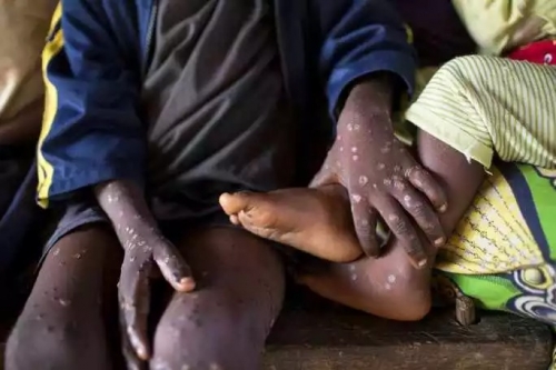 Châu Phi công bố 103 ca tử vong do đậu mùa khỉ, cảnh báo đường lây khác-1