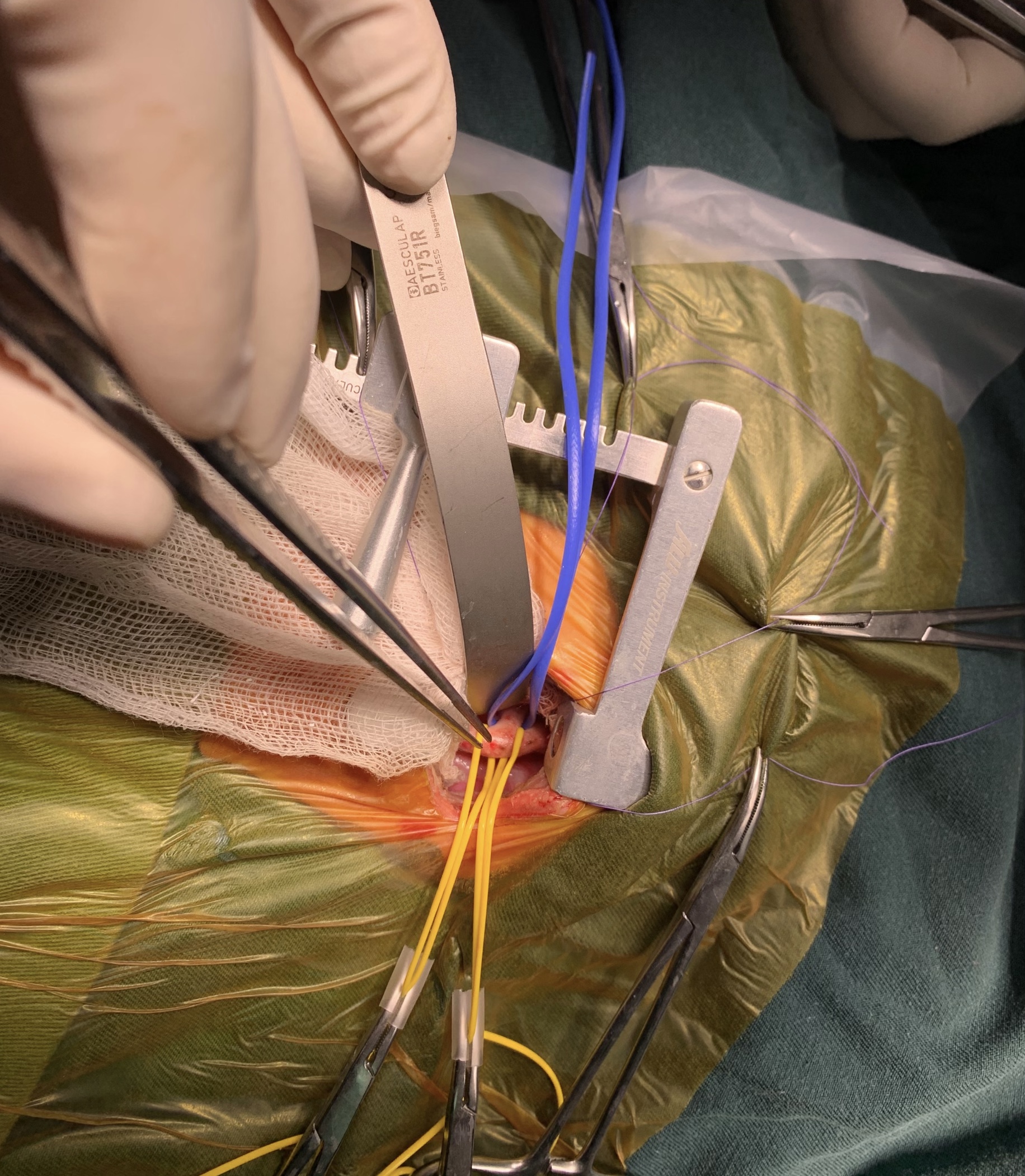 Đại phẫu thắt ống động mạch cho trẻ sơ sinh 10 ngày tuổi-2
