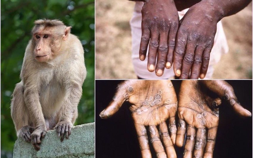 WHO nâng mức cảnh báo cao nhất, ban bố tình trạng khẩn cấp vì bệnh đậu mùa khỉ-1