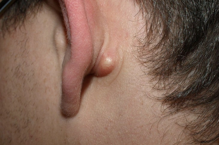 Nổi hạch sau tai: Trường hợp nào là dấu hiệu ung thư-1